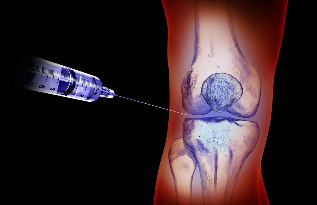 intra-articular injection para sa arthrosis