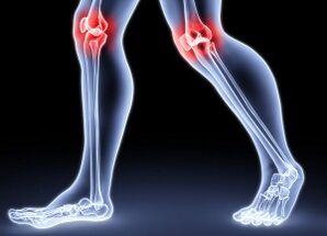 Ang mga kadahilanan para sa pagbuo ng arthrosis ng tuhod
