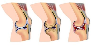 Mga yugto ng pag -unlad ng arthrosis ng kasukasuan ng tuhod