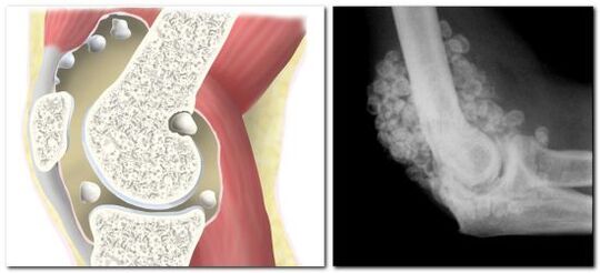 chondromatosis na may sakit sa hip joint