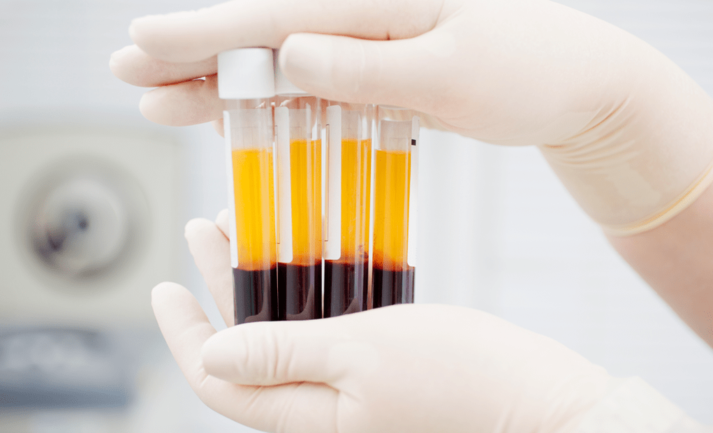 Platelet-rich plasma para sa PRP therapy para sa arthrosis